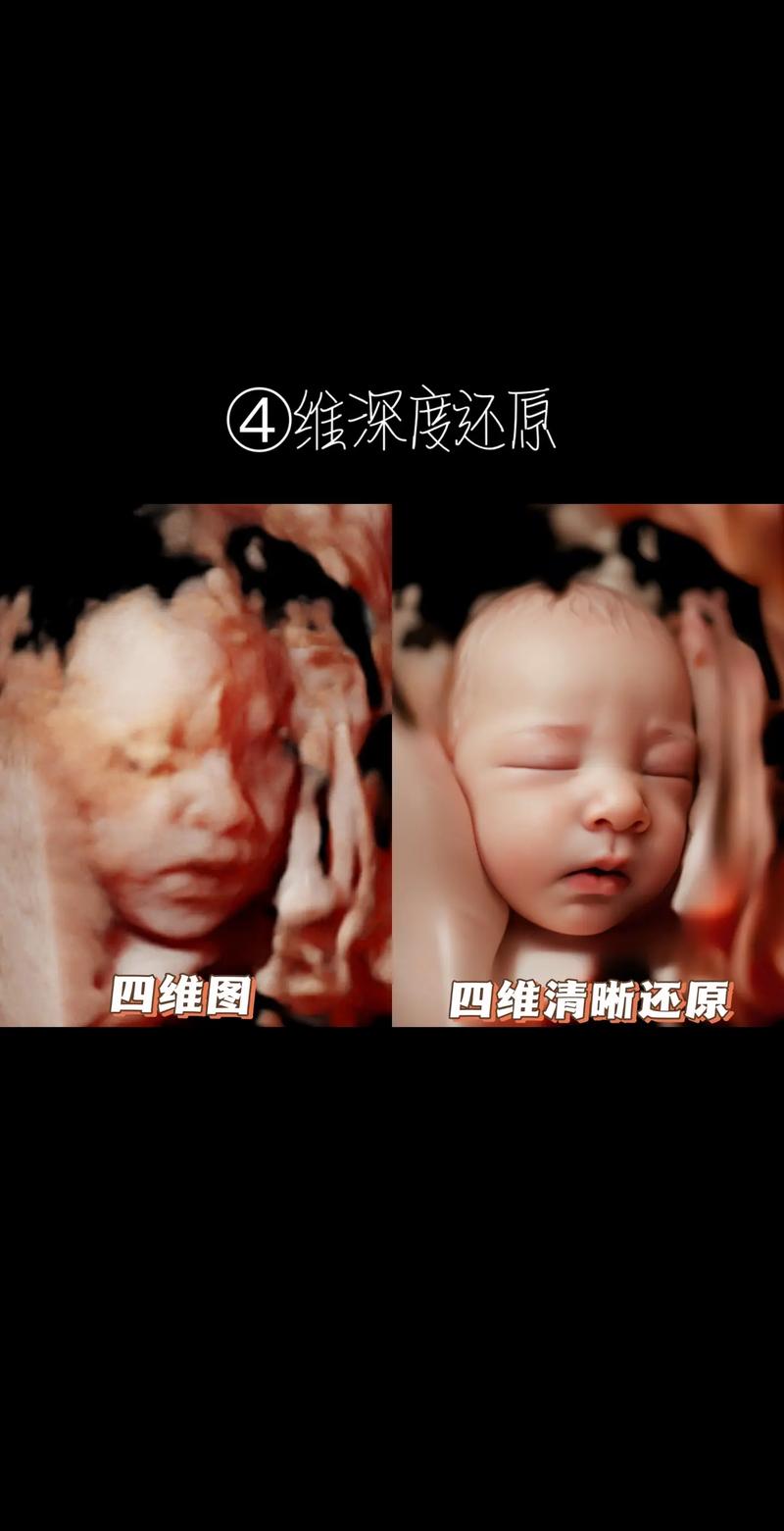 四维彩超